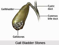 Symptoms of Gall Bladder Stones