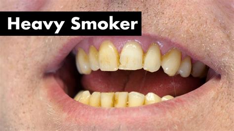 Cleaning Smoker's Teeth with Heavy Stain | Teeth Cleaning - Dental Clinic