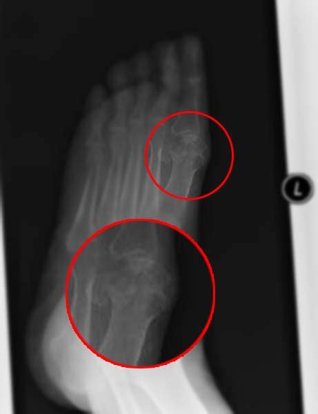 Gout x ray - wikidoc