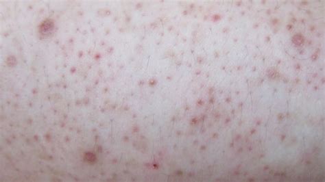 What is keratosis pilaris? - Reviewed