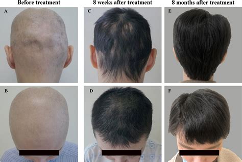 Frontiers | Case Report: Reversal of Long-Standing Refractory Diffuse Non-Scarring Alopecia Due ...