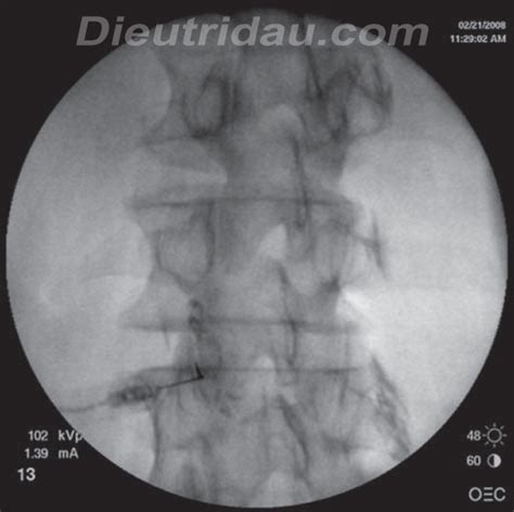 Zygapophyseal Joint Injection - Pain Management