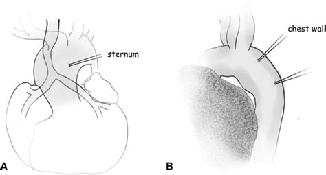 Outcomes of Aortopexy for Patients With Congenital Heart Disease | SpringerLink