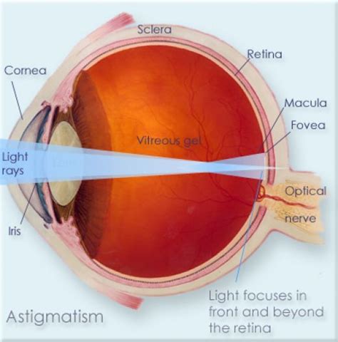 Astigmatism | Health Blog Site