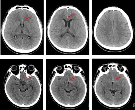 Ruptured ACOM aneurysm – Radiology Cases