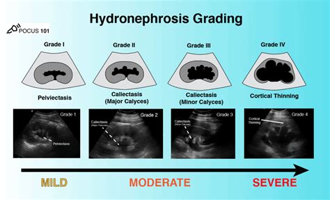 Hydronephrosis Grading Ultrasound