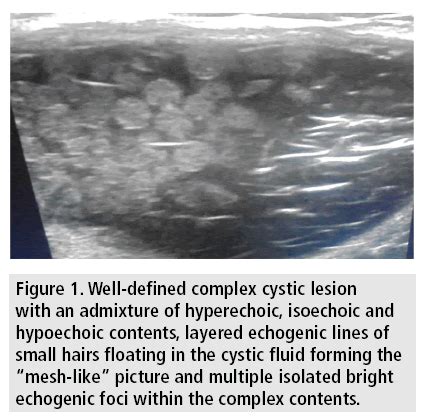 Subcutaneous Dermoid Cyst Ultrasound