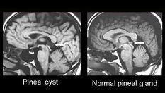 Pre-Operation stories | Pineal Cyst Awareness