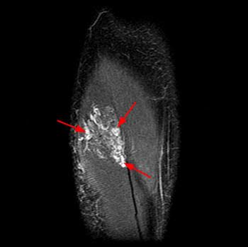 Venous Malformations - Radsource