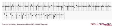 Artificial pacemaker - wikidoc
