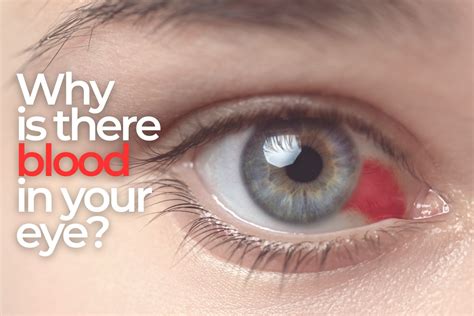 Subconjunctival Hemorrhages: Why Is There Blood In My Eye? - EZOnTheEyes