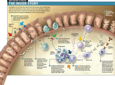 Celiac Disease - Diagnosis, Symptoms, Treatment, Diet & Foods to Avoid