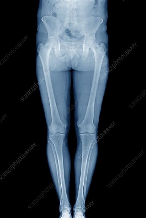 Healthy leg bones, X-ray - Stock Image C003/7261 - Science Photo Library