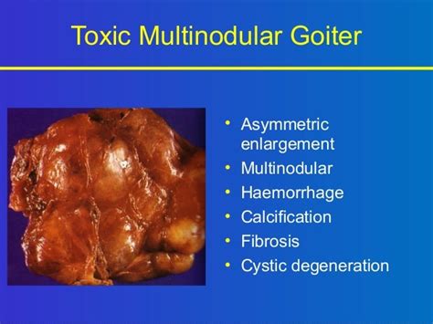 Goiter