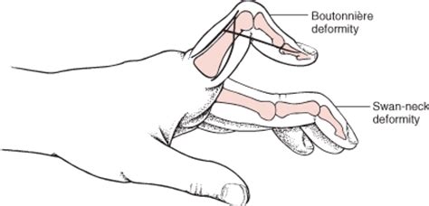 Table: Boutonnière and swan-neck deformities - MSD Manual Professional ...