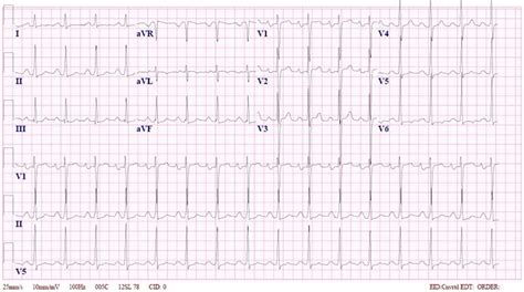 Left Ventricular Hypertrophy ECG (Example 2) | Learn the Heart