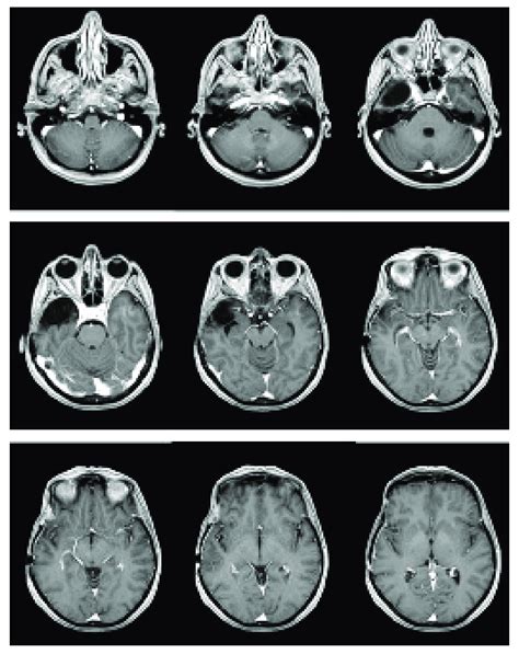 Contrast-enhanced T1-weighted sequence images MRI, performed after... | Download Scientific Diagram