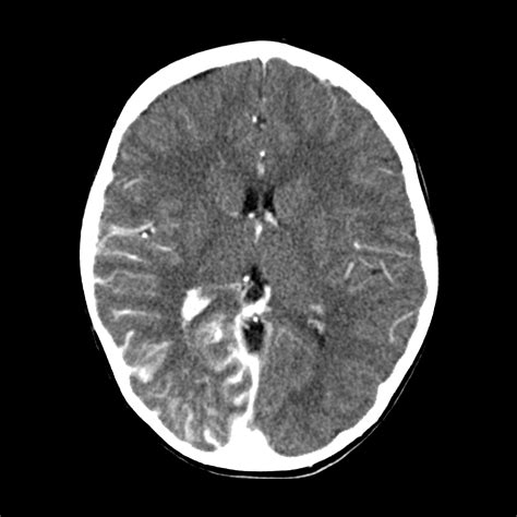 Sturge-Weber Syndrome | Pediatric Radiology Reference Article ...