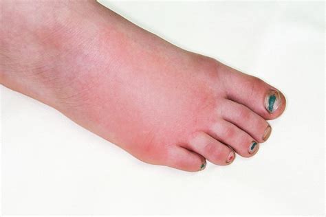 Allergic Reaction To Insect Bite Photograph by Dr P. Marazzi/science ...