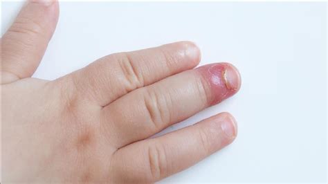 how to get rid of hangnail infection - YouTube