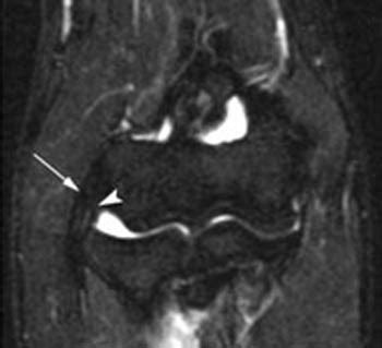 MRI Musculo-Skeletal Section: Radial collateral ligament pathology