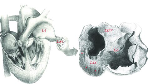 Left atrial appendage anatomy (classic 'chicken wing' morphology). The ...