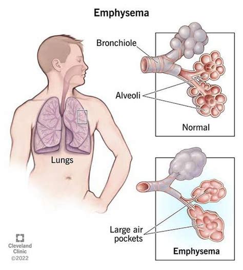 Symptoms of emphysema - MEDizzy