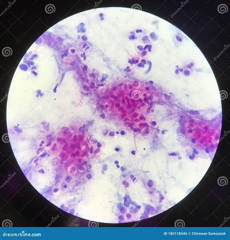 Red Branching Mycobacterium Tuberculosis on Blue Background in Modified ...