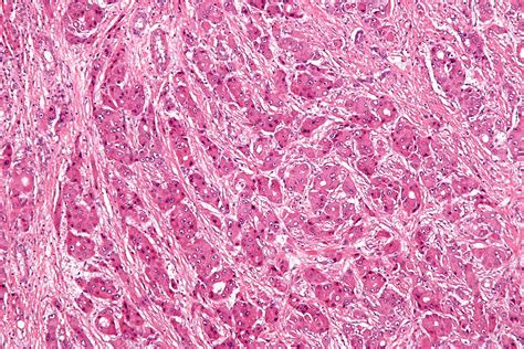 File:Fibrolamellar hepatocellular carcinoma - intermed mag.jpg - Wikimedia Commons