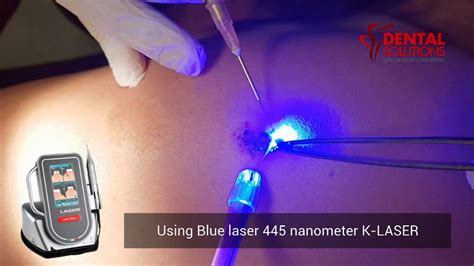 Wart removal using laser - YouTube