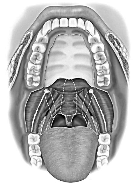 Barbed snore surgery | Sonnomedica