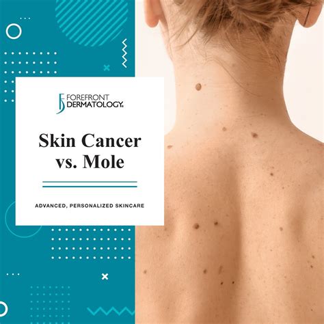 List 98+ Pictures Anatomy Of A Mole On The Skin Updated