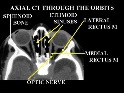 CT Scan Tips & Protocols: CT Orbit anatomy