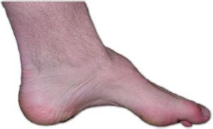 How to decrease pain with High arch foot(cavus foot) exercises? - Texas Foot and Ankle ...