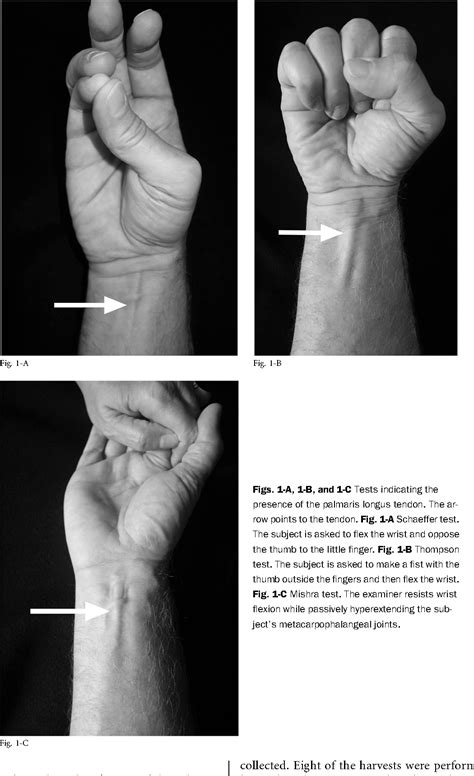 Inadvertent Harvest of the Median Nerve Instead of the Palmaris Longus ...