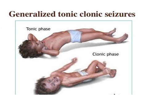 Generalized Tonic Clonic Seizures (Epilepsy) treatment in India : Cost, Hospitals & Doctor