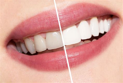 Teeth Whitening Costs and Information - The Dental Guide