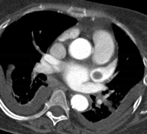 Thrombus Of Left Atrial Appendage