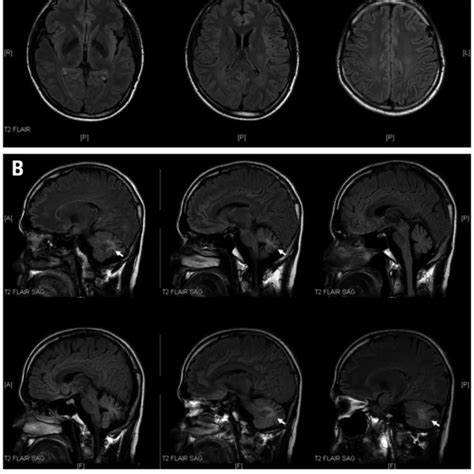 (A) T2 magnetic resonance imaging (MRI) of the brain showed hypointense... | Download Scientific ...