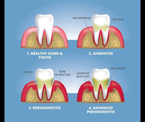 5 Foods That Promote Healthy Teeth And Gums - Arcadia Perio for ...