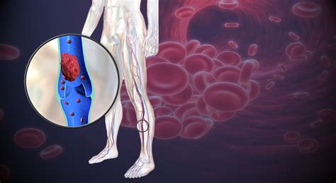 Symptoms of Blood Clot in Leg • MyHeart