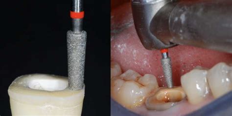 The Endocrown: A Different Type of All-Ceramic Reconstruction for Molars | JCDA