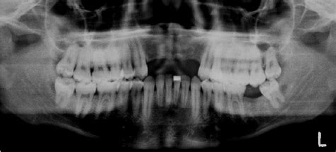 Case 2: orthopantomogram | Download Scientific Diagram
