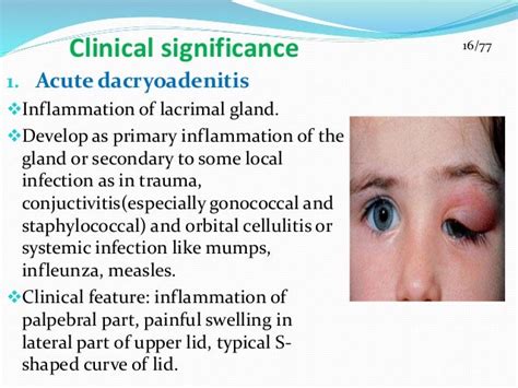 Suraj ..lacrimal appartus ppt (2)