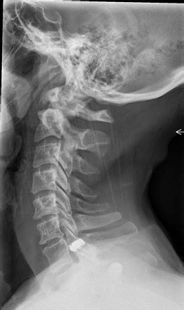 Os odontoideum | Image | Radiopaedia.org