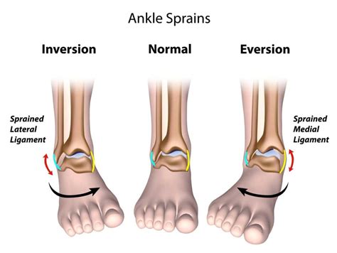 Lateral Ligament Injury - Sports Medicine Information