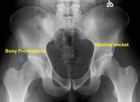 PAO surgery for hip dysplasia in an active 25 year old male | St. Louis Hip Surgeon John C. Clohisy