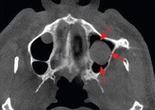 Maxillary Sinus Polyps Cysts