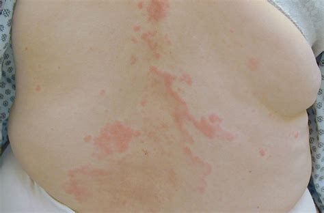 Contact dermatitis rash pictures | Symptoms and pictures