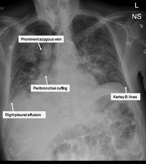 Pulmonary Edema Vs Normal Chest X Ray